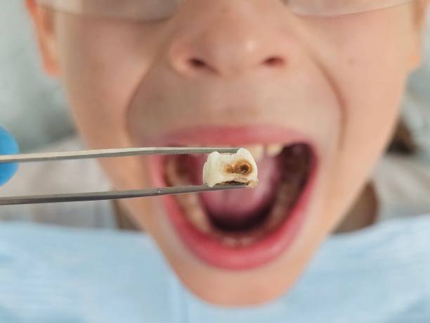 Best Emergency Treatment for Dental Infections or Abscesses in Brandon, MS