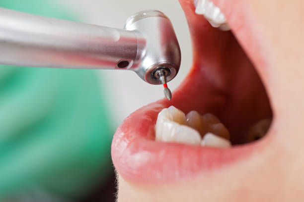 Best Emergency Dental Care for Broken or Chipped Teeth in Brandon, MS